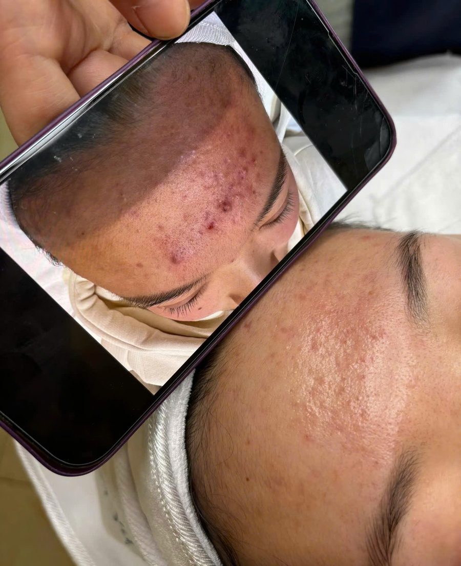 Before After mụn