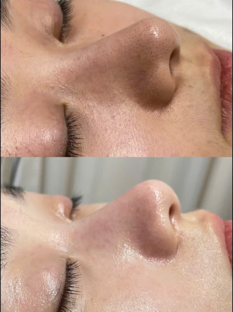Before After chăm sóc mụn Comodex by Christina