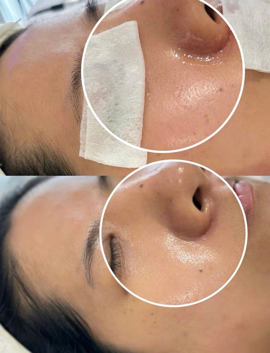 Before After mặt